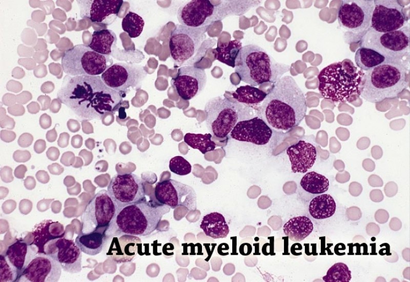 Leukemia, Myeloid, Acute
